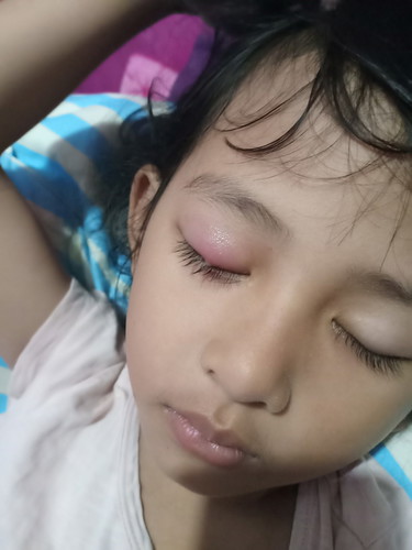 Obat buat mata bintilan anak