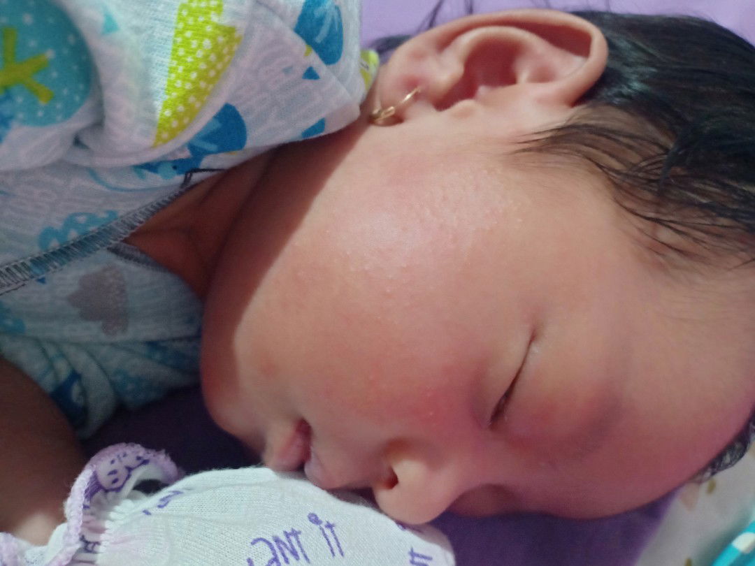 bintik " merah d.pipi