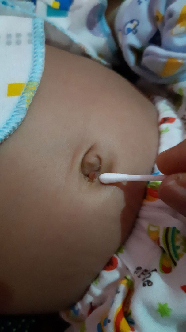 daging tumbuh di pusar