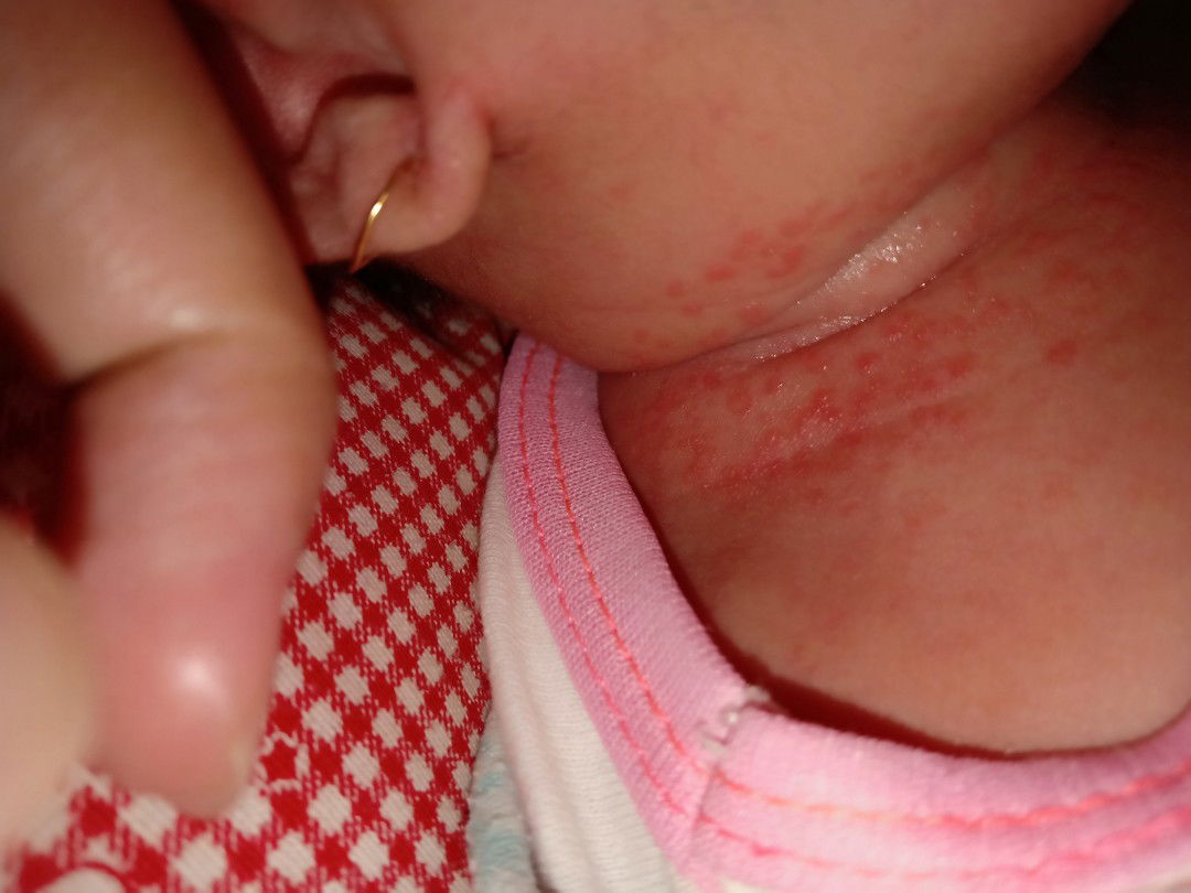 bintik merah pada leher