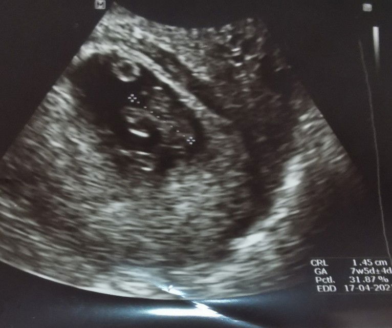 ไปซาวด์มาค่ะ คุณหมอเเจ้งว่าเห็นเงาๆน่าจะเป็นเเฝด เเม่ลุ้นมากๆค่ะ