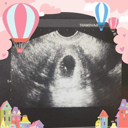 รัดหน้าท้องตอนตั้งครร