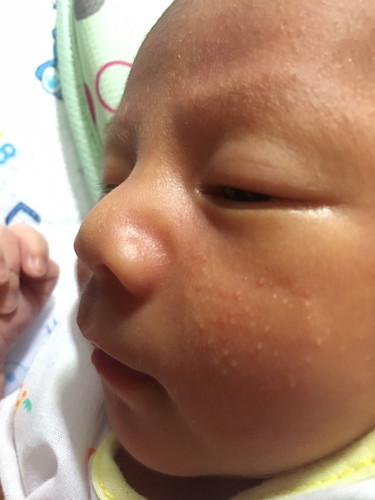 ผื่นแพ้ ทำยังไงถึงหาย???