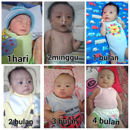 radang paru(pneumonia)