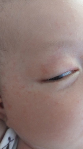 Pipi Baby Bruntusan