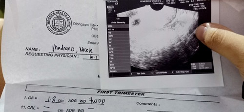 Gestational Sac no yolk sac