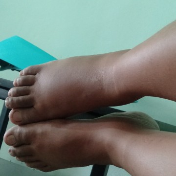 เท้าบวม