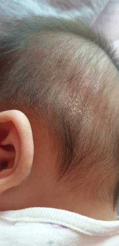 หนังศรีษะ-ผิวลูกแห้งเป็นแผ่น-ขุย