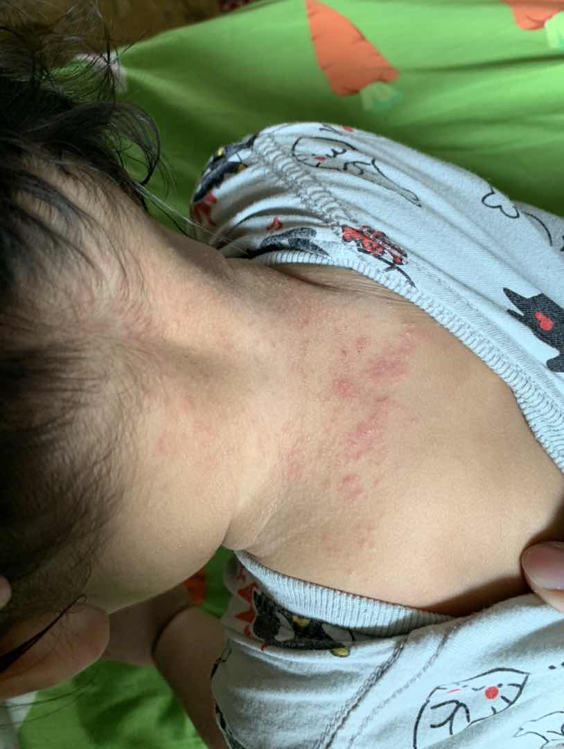 ลูกสาวขึ้นผื่นแบบนี้มาได้2-3 วัน แล้วยังไม่หายอีก ต้องใช้ยาอะไรทาถึงจะดีขึ้นค่ะ ช่วงนี้โลชั่น Eucerin baby cream อยู่ค่ะ