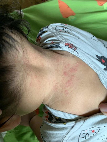 ลูกสาวขึ้นผื่นแบบนี้มาได้2-3 วัน แล้วยังไม่หายอีก ต้องใช้ยาอะไรทาถึงจะดีขึ้นค่ะ ช่วงนี้โลชั่น Eucerin baby cream อยู่ค่ะ