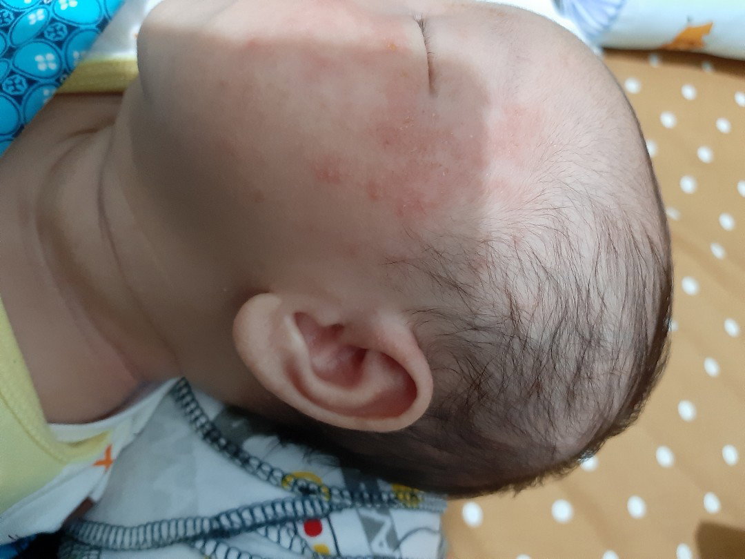 ruam pada kulit bayi