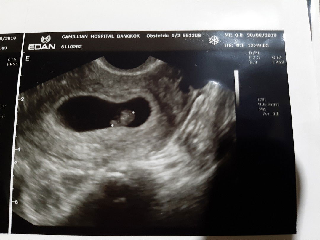 มีคุณแม่ท่านไหนหลังจากผ่าคลอด 3เดือน แล้วตั้งท้องต่อเลยบ้างคะ??‍♀️