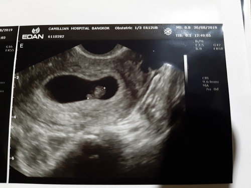 มีคุณแม่ท่านไหนหลังจากผ่าคลอด 3เดือน แล้วตั้งท้องต่อเลยบ้างคะ??♀️