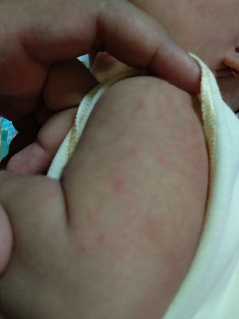 merah2 dibadan bayi