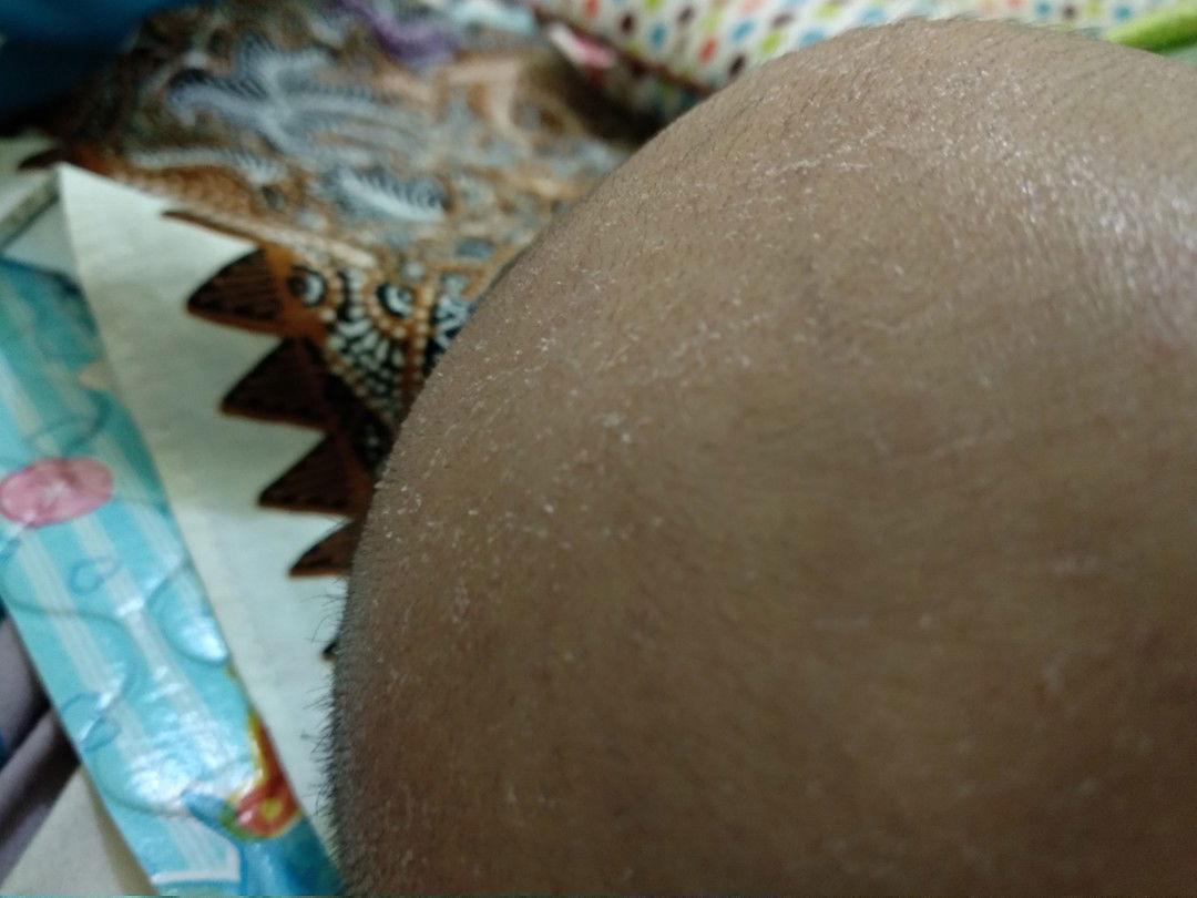kulit kepala bayi