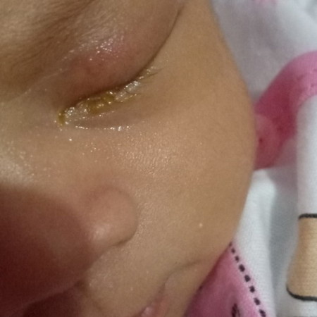 sakit mata pada bayi