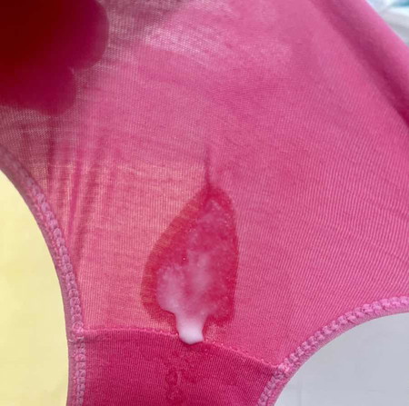 Discharge of amniotic fluid
