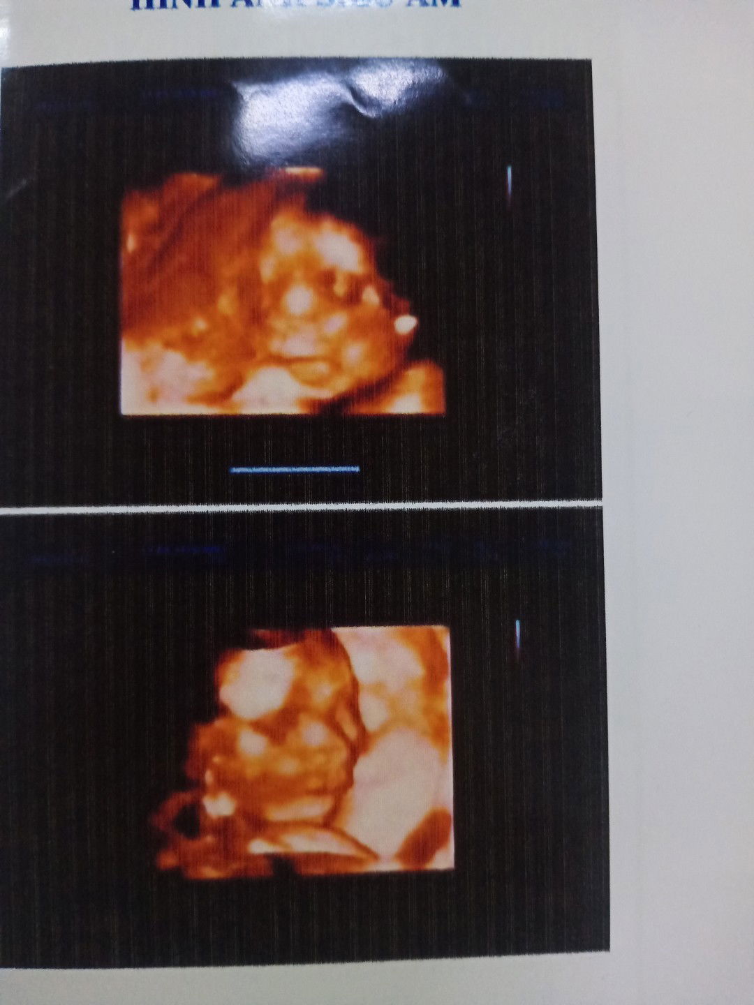 Con e lúc 23tuần2 ngày nặng 500g có sao không mọi người? E lo quá