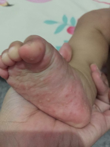 Bayi Gatal