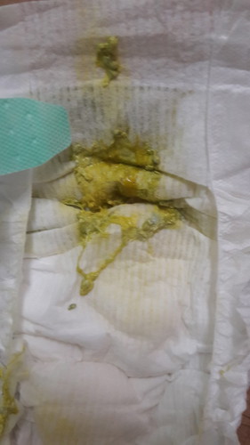 ลักษณะอุจจาระผิดปกติมั้ย