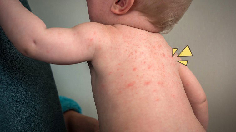 skincare yang bagus untuk anak kulit kering dan biang keringat.