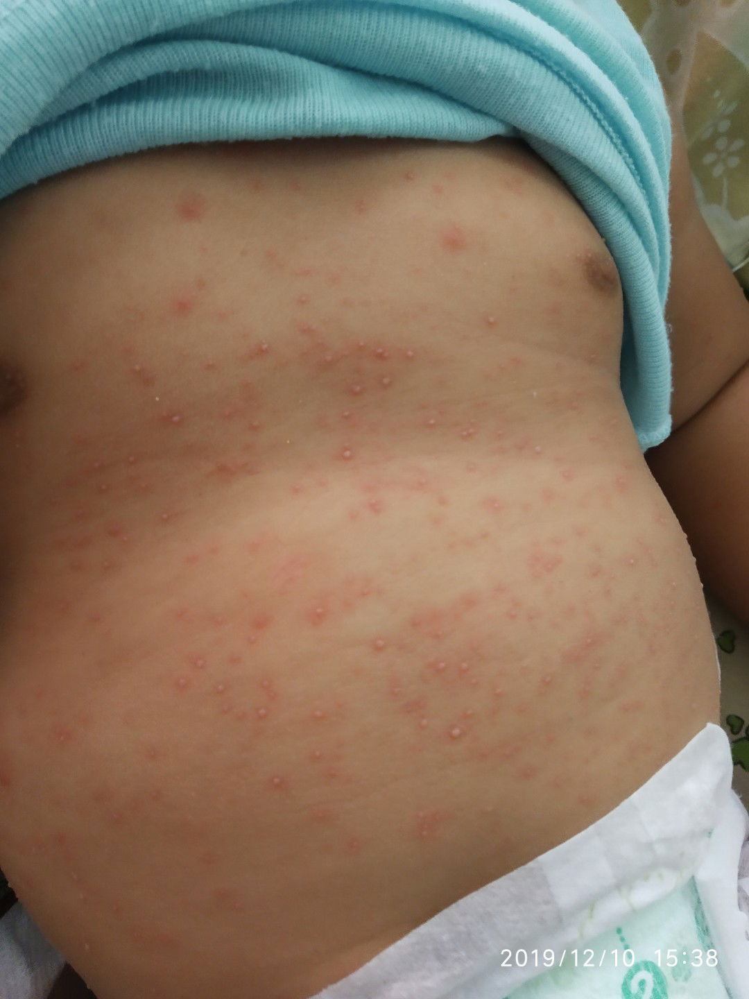 cacar atau gatal" lain???