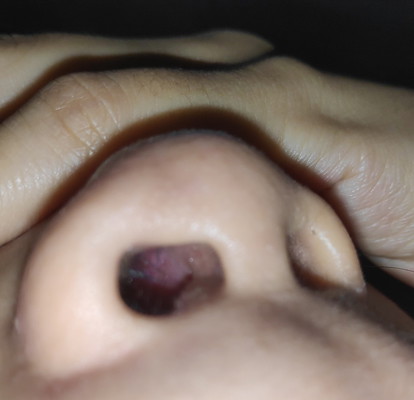hidung bengkak