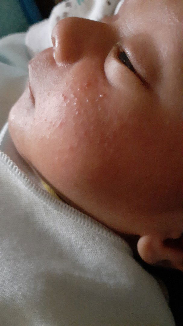 bintik merah pada wajah (kebanyakan pipi) bayi