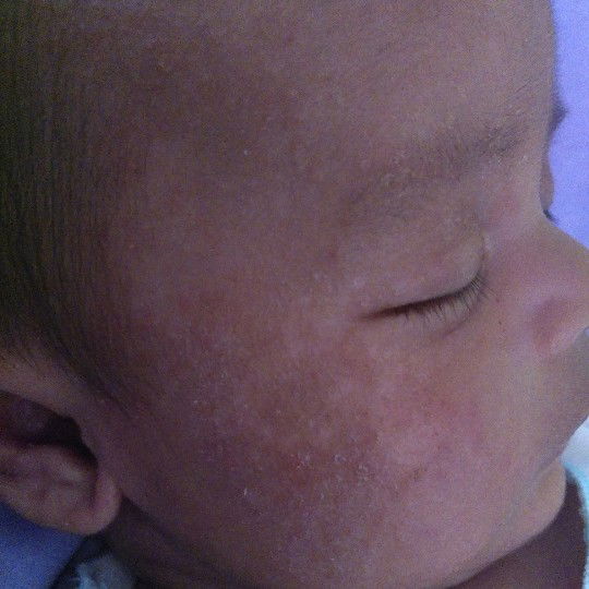 biang kringat atau ruam susu