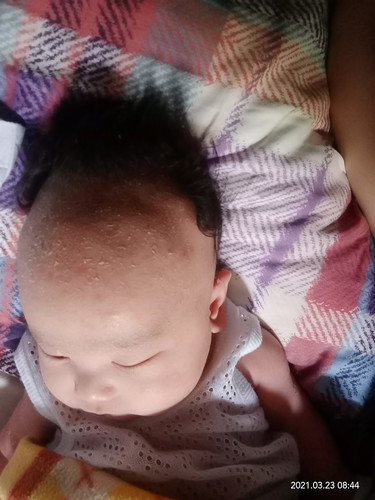 Mommy ano kaya ang gamot sa pagtutuklap ng balat ni baby sa ulo o ano kaya sabon dapat gamitin.