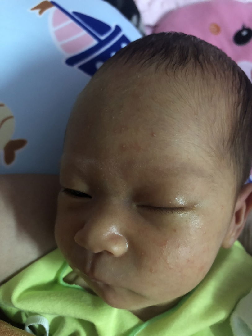 ลูกๆบ้านไหนเป็นผื่นแบบนี้บ้างค่ะ