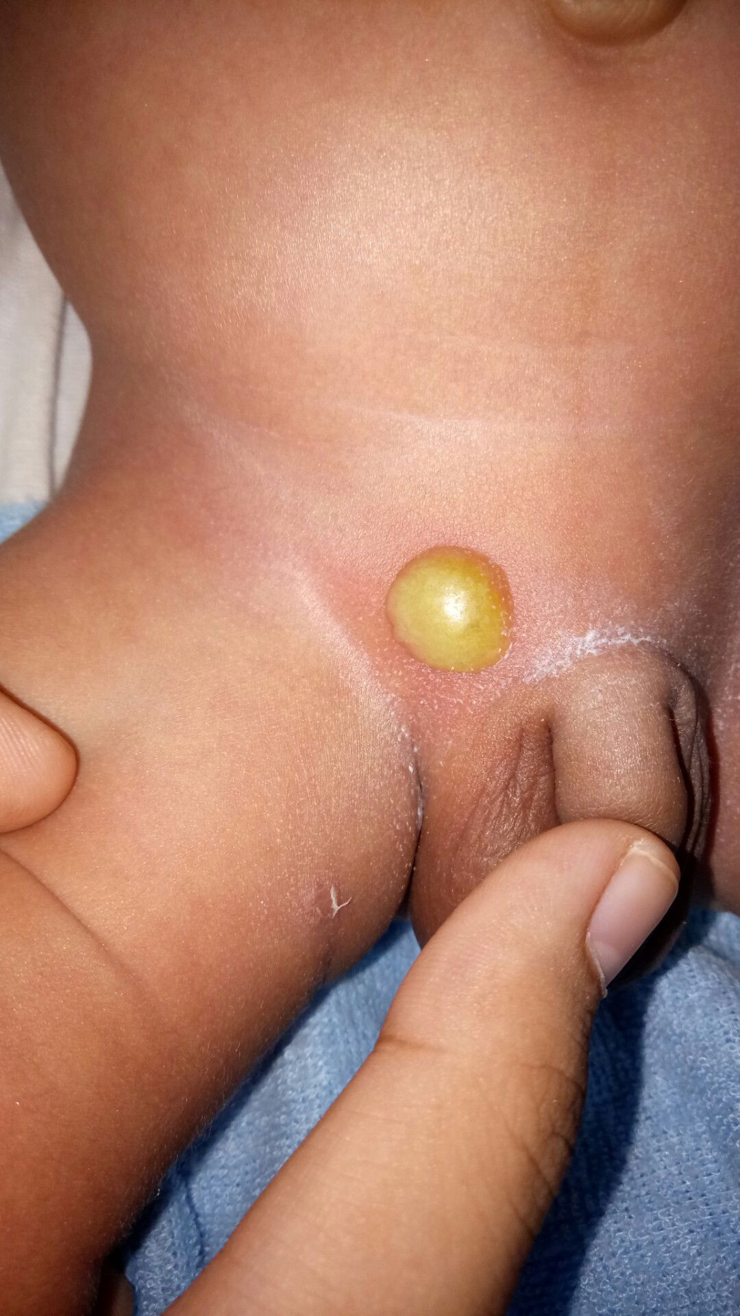 benjolan isi nanah di daerah kemaluan baby boy