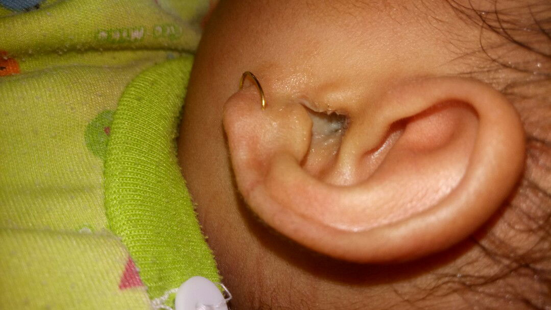 telinga bayi mengeluarkan cairan