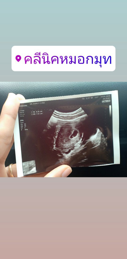 สอบถามค่ะ ท้องแรก