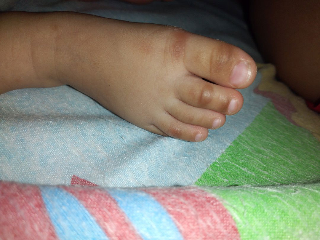 kulit jari kaki menghitam