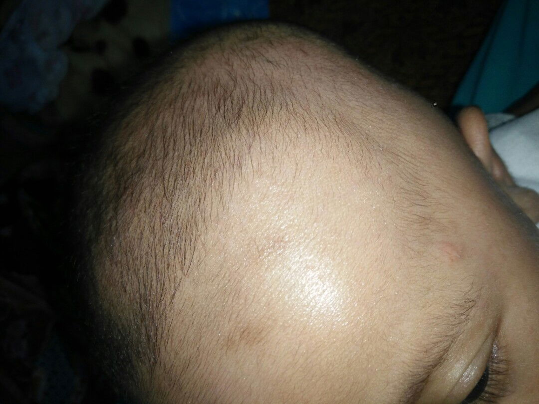 bekas gigitan nyamuk