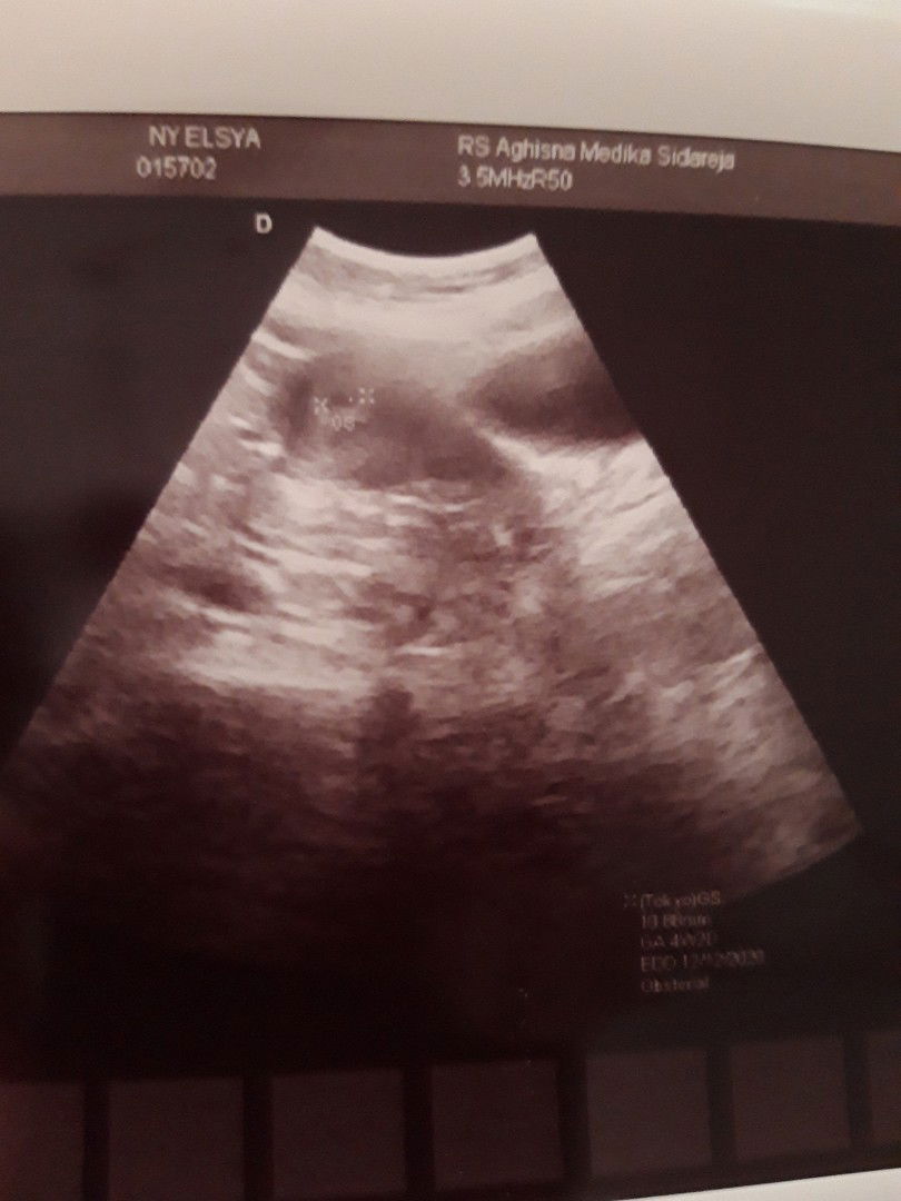 Hamil disertai kista