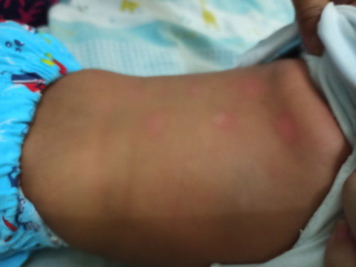 bercak putih pada bayi