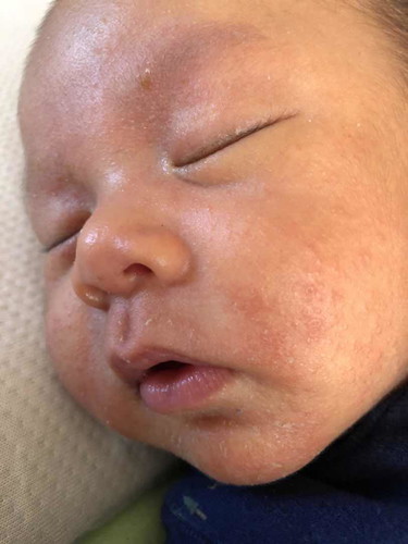 ผดหรื่อผื่นค่ะ ใครเป็นบ้างอันตรายไหมค่ะ