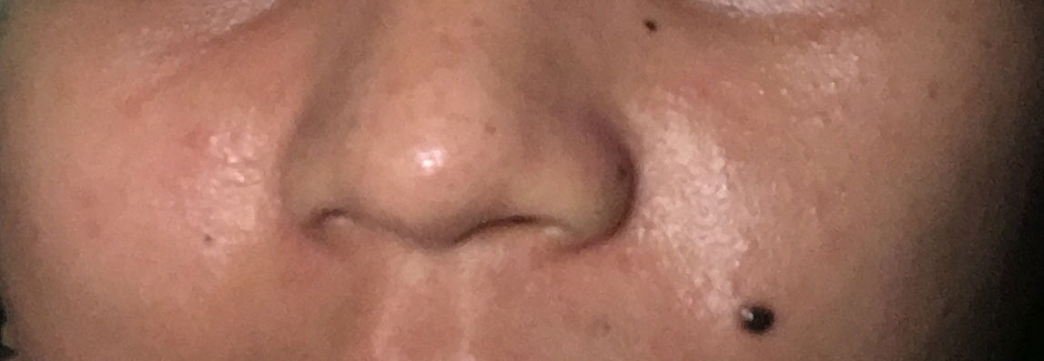 Wajah kasar dan bintik kemerahan usai melahirkan