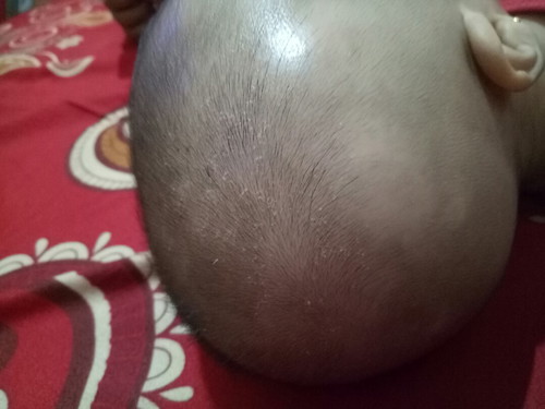 kulit kepala bayi bersisik dan pitak