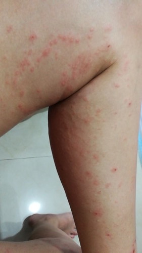 ใครเป็นผื่นหลังคลอดบ้างคะ จะหายได้ไหม