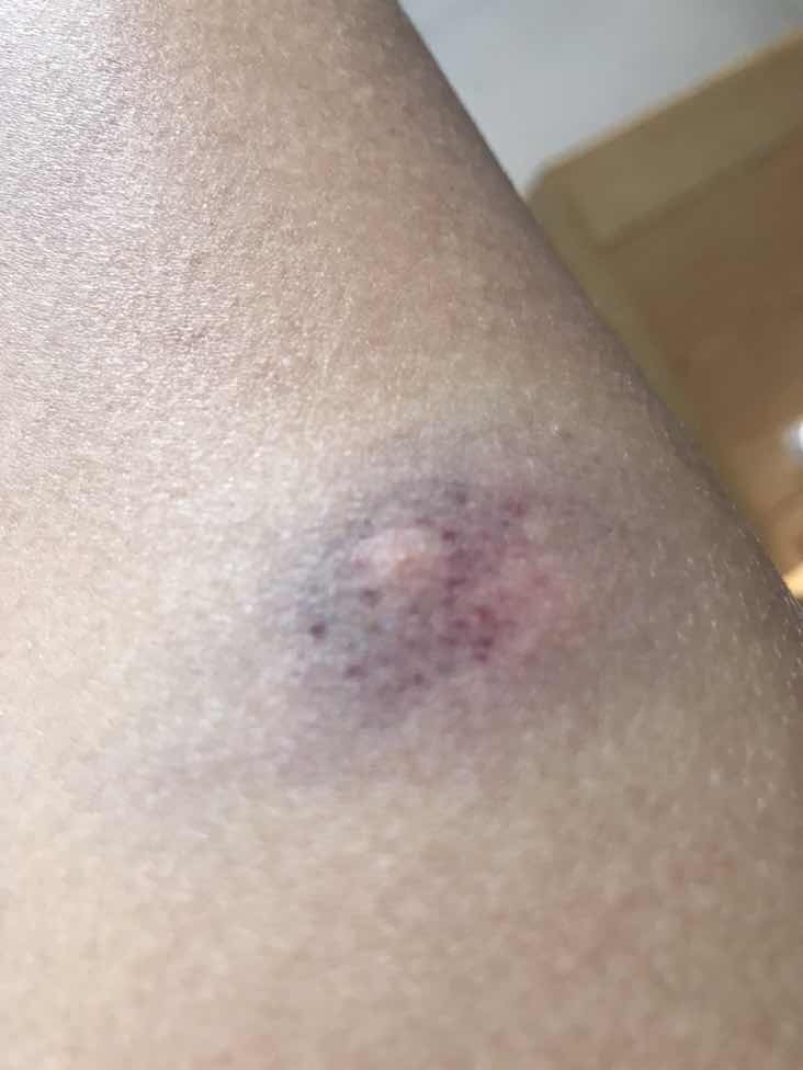 Có mom nào chích ngừa mà bị như em hông