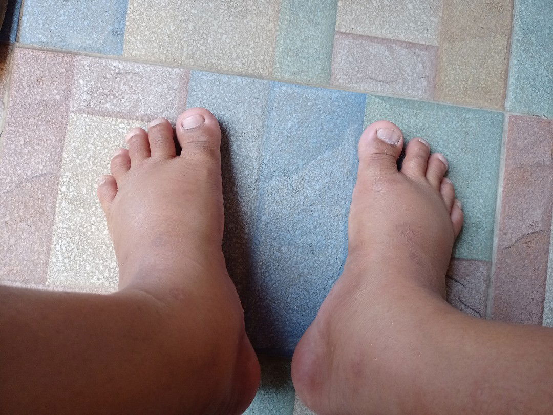 37w5d
ตอนนี้ใส่รองเท้าคู่ใหญ่สุดก็ยังแน่น ใครที่บวมแบบนี้บ้างคะ