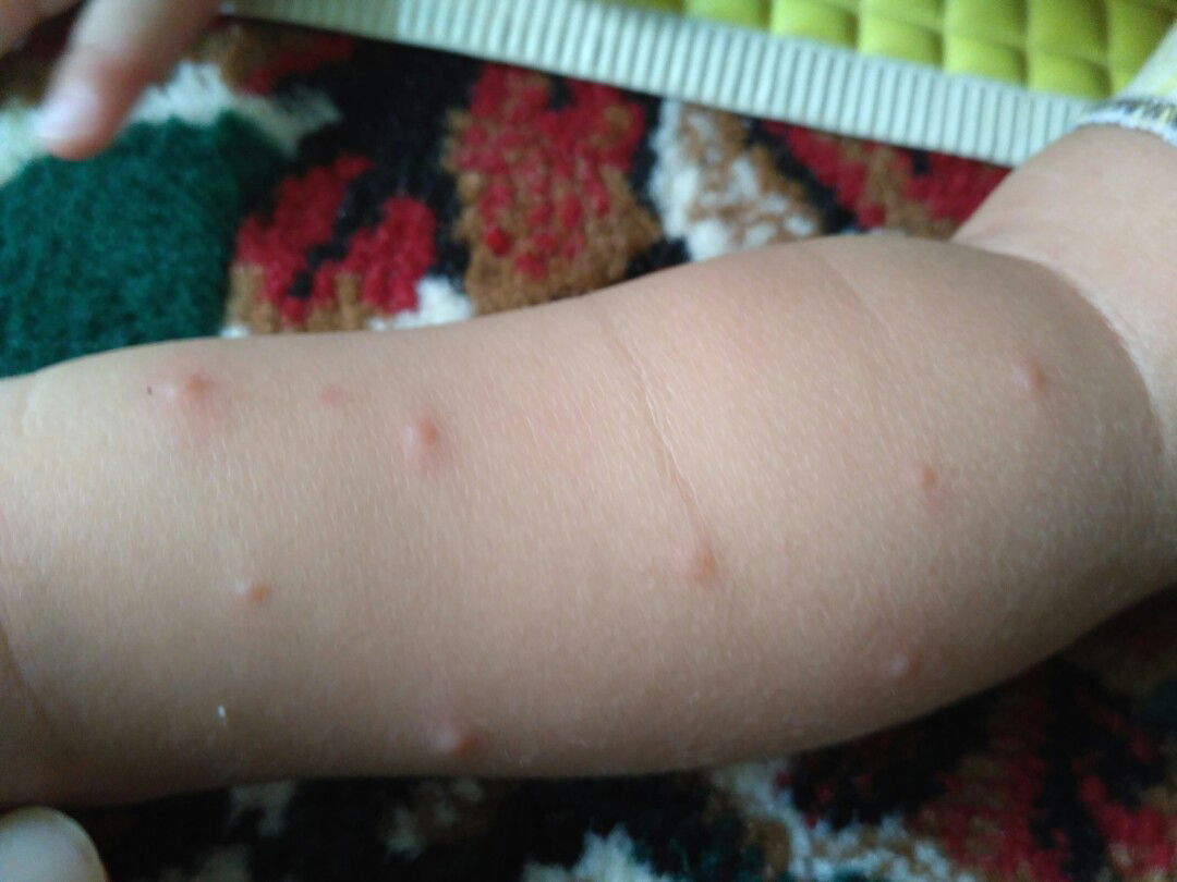 gigitan nyamuk/alergi/cacar?