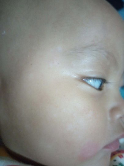 bercak putih seperti panu