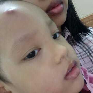 ลูกเป็นฝีที่หัวบวมทั้งหน้า