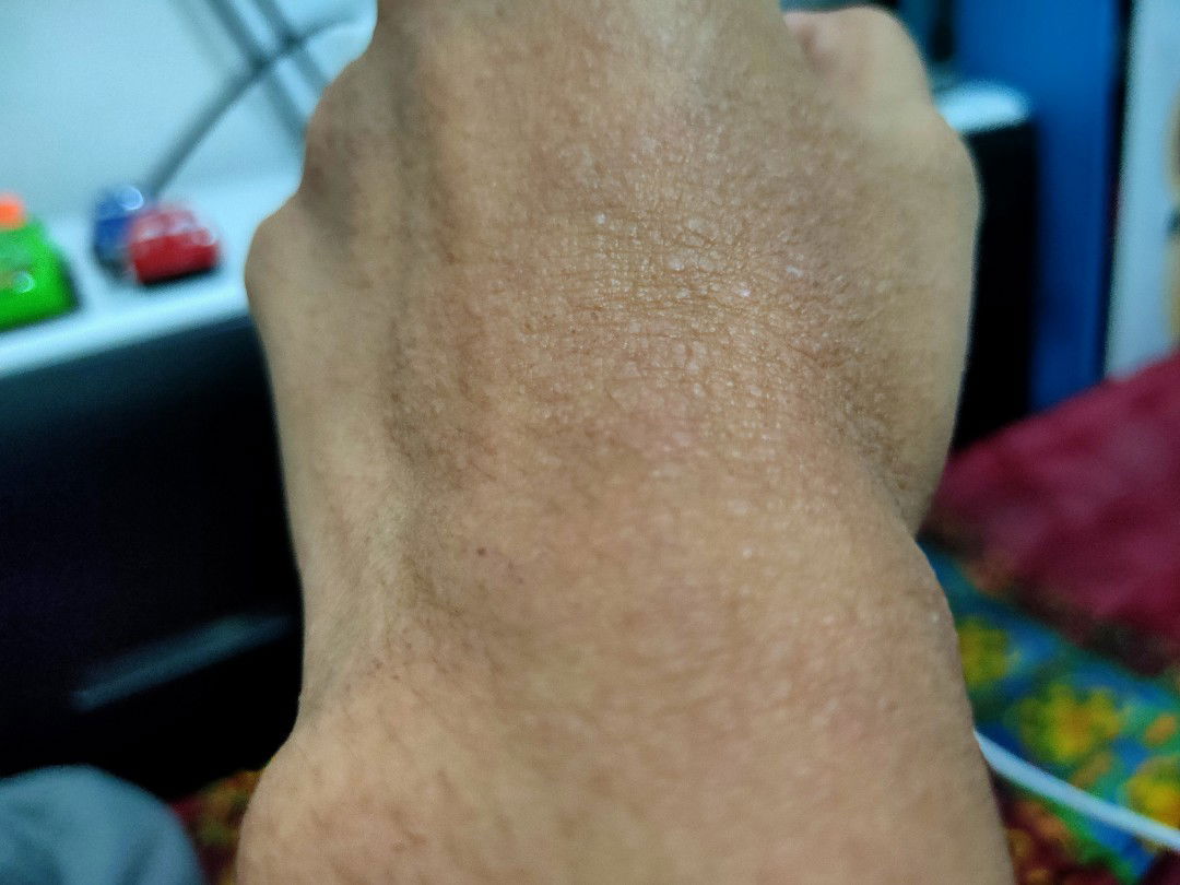 gatal dan sariawan saat hamil