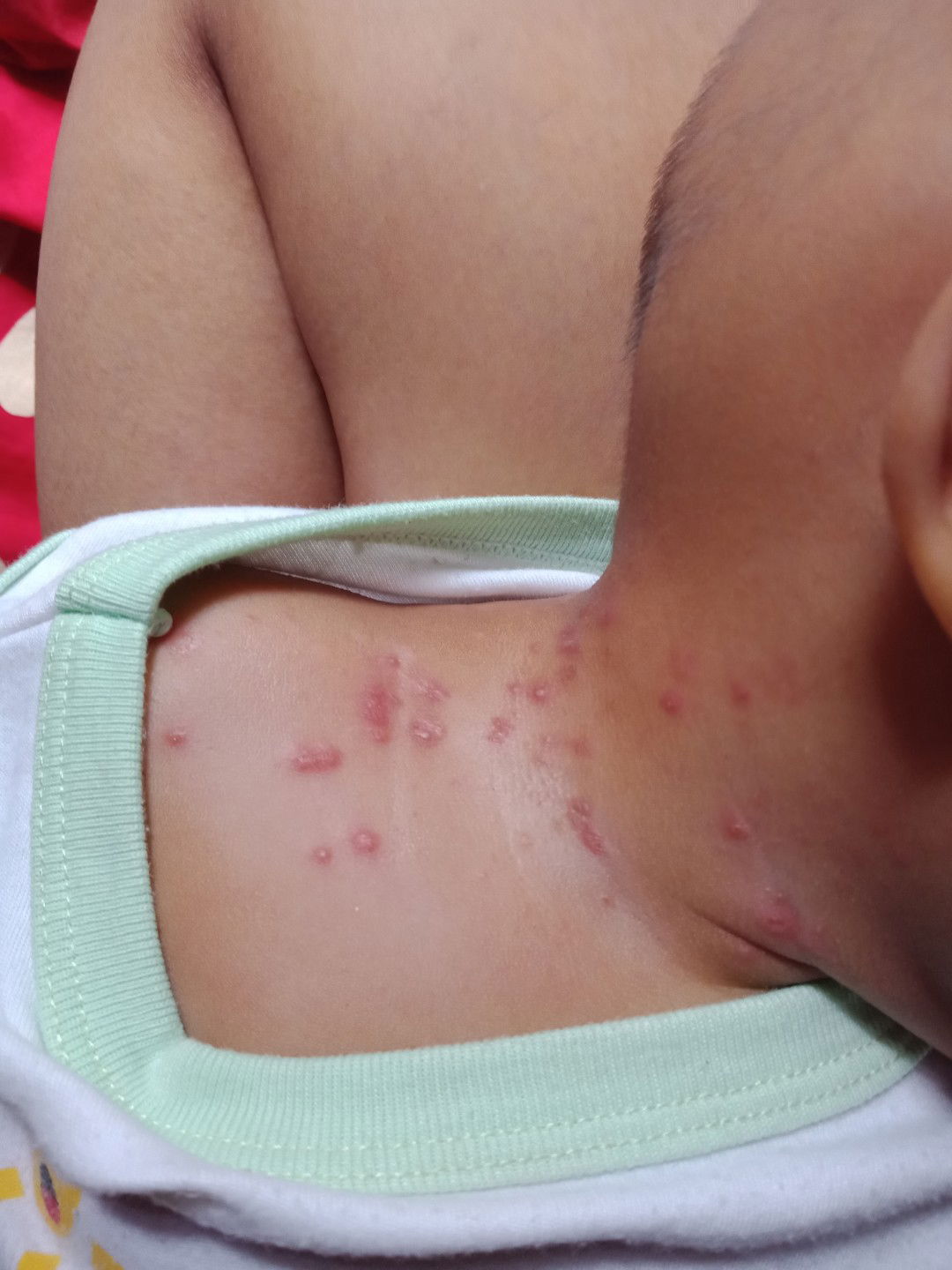 bintik merah dan menyebar pada bayi 8 bulan