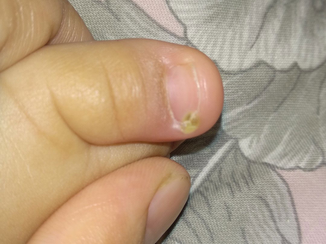 kuku jempol bayi memerah